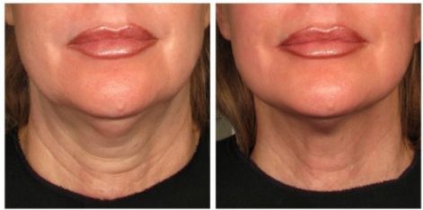 ultherapy_lower_face_2-7-e1356020681690.jpg
